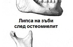 Остеомиелит на челюстите
