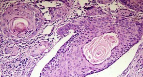 Рак на белия дроб – Синдром на Pancoast-Tobias