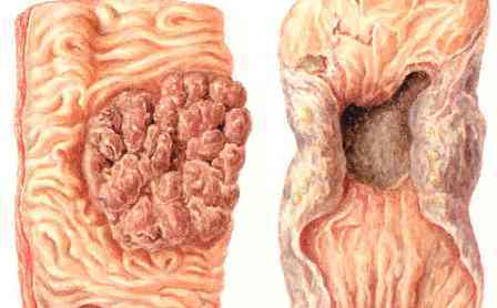 рак на дебелото черво