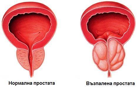 нормална и възпалена простата