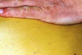 Жълтеница – причини, симптоми и видове
