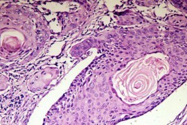 Рак на белия дроб – Синдром на Pancoast-Tobias