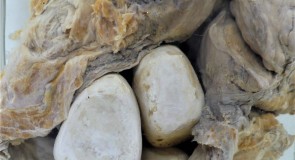 Камъни в пикочния мехур – лечение, причини и снимки
