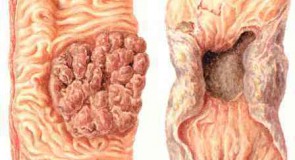 Рак на дебелото черво – симптоми и лечение